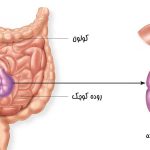 علت پیچ خوردن روده