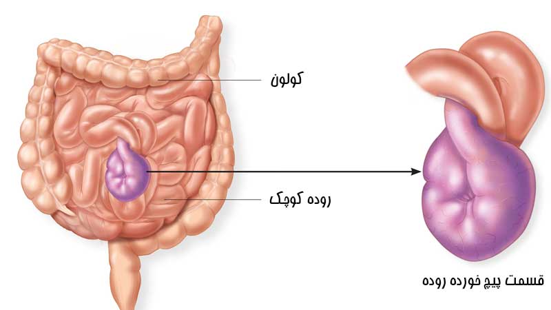 علت پیچ خوردن روده