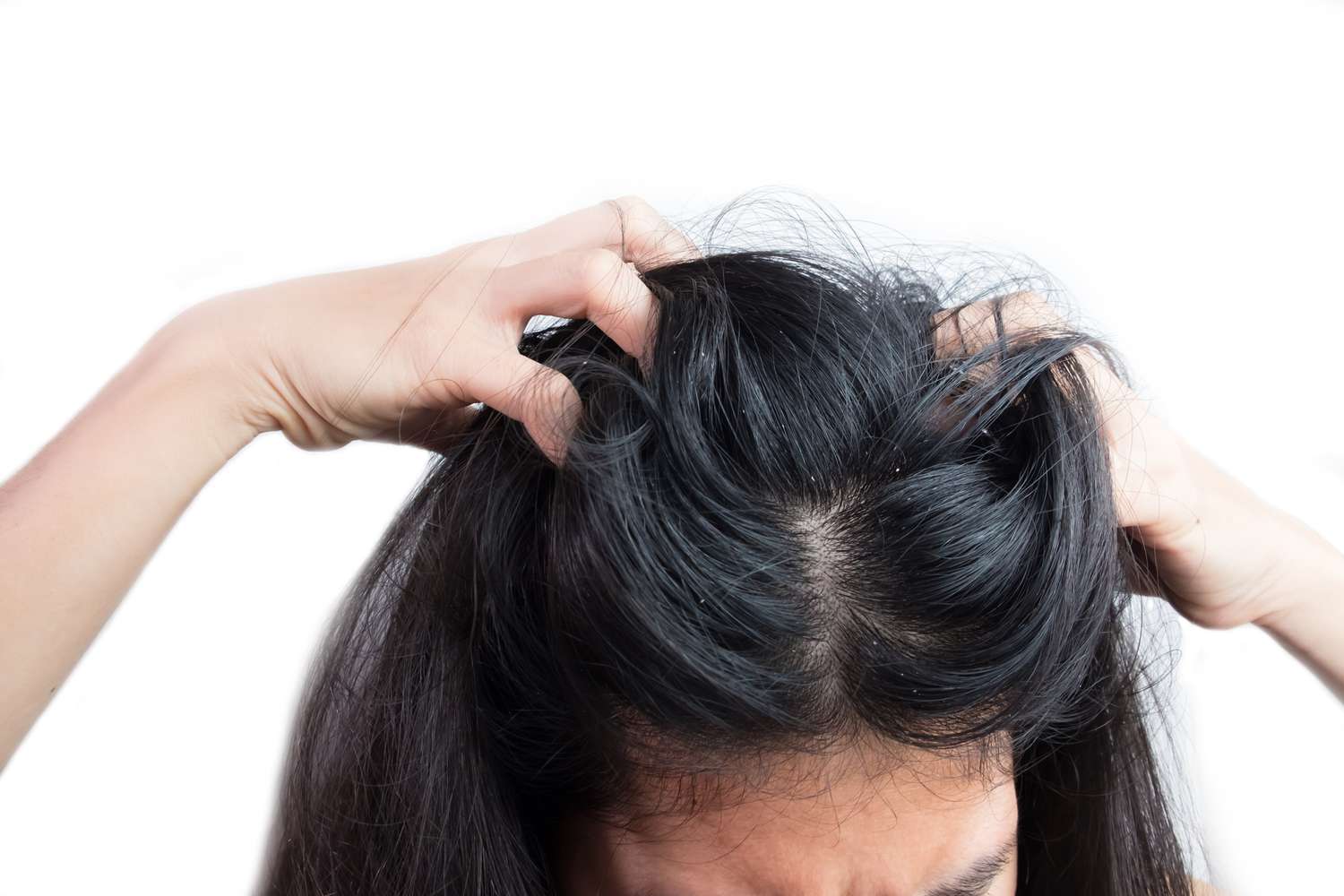 علائم شوره و قارچ سر