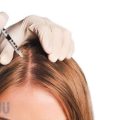 What-is-hair-mesotherapy